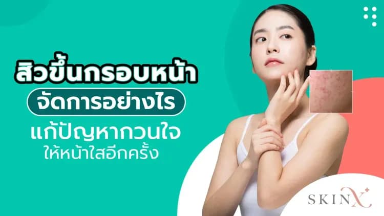 สิวขึ้นกรอบหน้าจัดการอย่างไร แก้ปัญหากวนใจให้หน้าใสอีกครั้ง