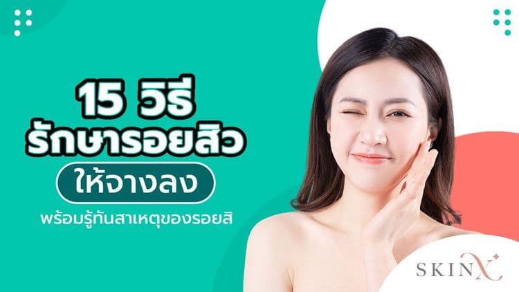 15 วิธีรักษารอยสิว ลดรอยดำ รอยแดงจากสิวให้จางหายเร็ว