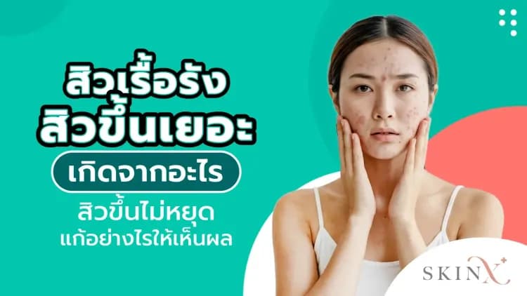 สิวเรื้อรัง สิวขึ้นเยอะเกิดจากอะไร สิวขึ้นไม่หยุดแก้อย่างไรให้เห็นผล