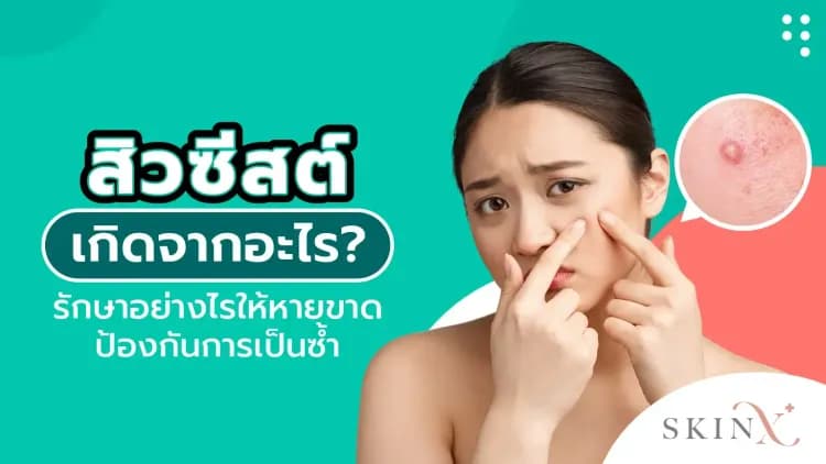 สิวซีสต์ เกิดจากอะไร? รักษาอย่างไรให้หายขาด ป้องกันการเป็นซ้ำ