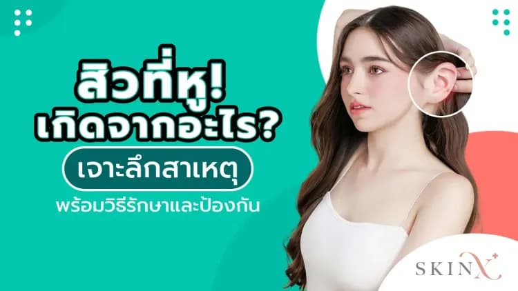 สิวที่หู เกิดจากอะไร? เจาะลึกสาเหตุ พร้อมวิธีรักษาและป้องกัน