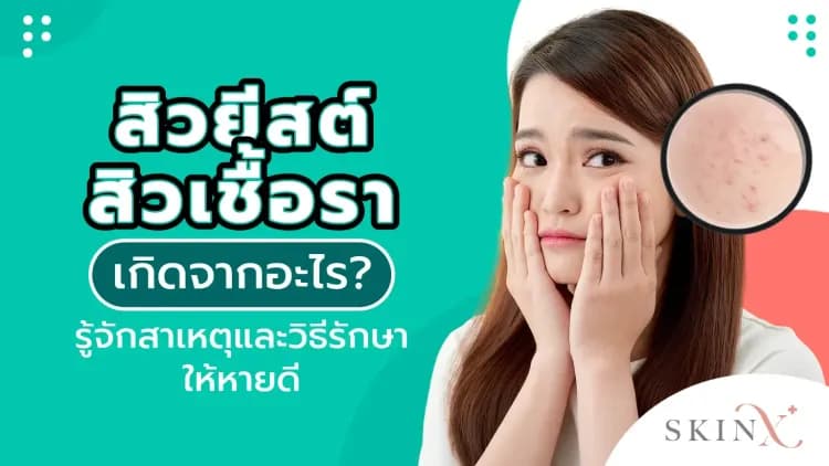สิวยีสต์ สิวเชื้อรา เกิดจากอะไร? รู้จักสาเหตุและวิธีรักษาให้หายดี