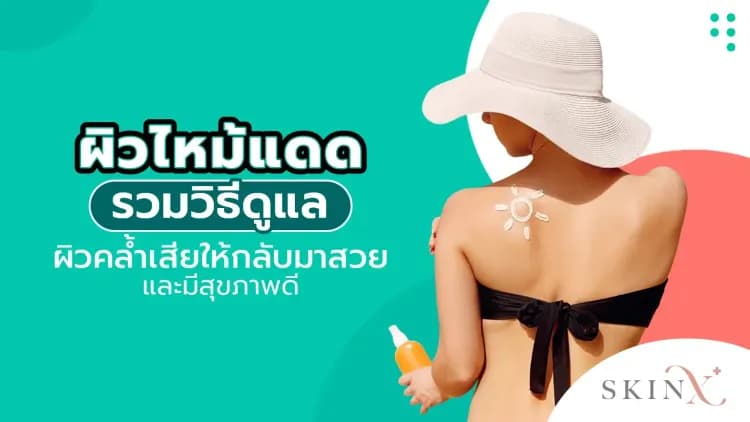 ผิวไหม้แดด รวมวิธีดูแลผิวคล้ำเสียให้กลับมาสวยและมีสุขภาพดี