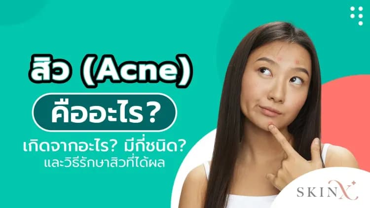 สิว (Acne) คืออะไร? เกิดจากอะไร? มีกี่ชนิด? และวิธีรักษาสิวที่ได้ผล