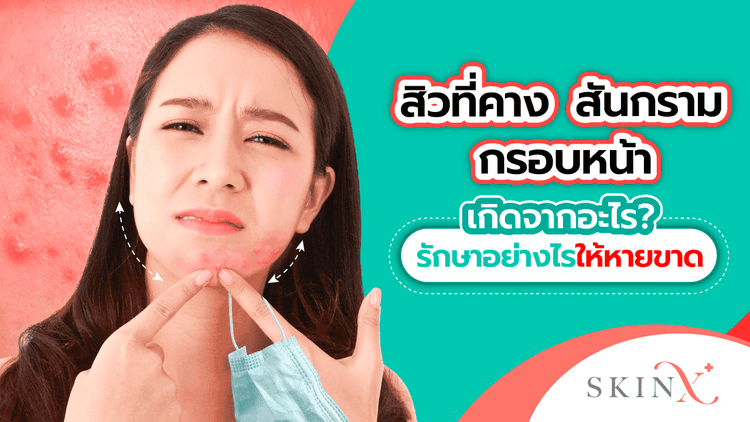 สิวที่คางเห่อ เกิดจากฮอร์โมนจริงหรือ?