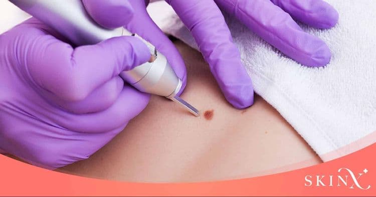 เลเซอร์ไฝ ตัวช่วยลบจุดดำกวนใจโดยไม่ทิ้งรอยแผลเป็น