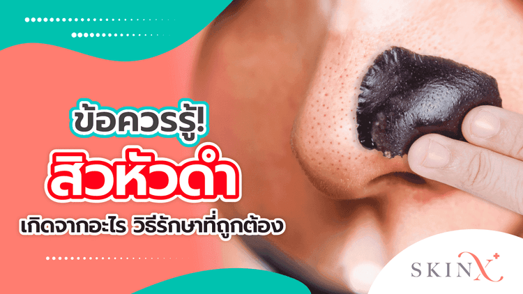 “สิวหัวดำ” ปัญหาผิวที่ใครๆก็ไม่อยากเจอ
