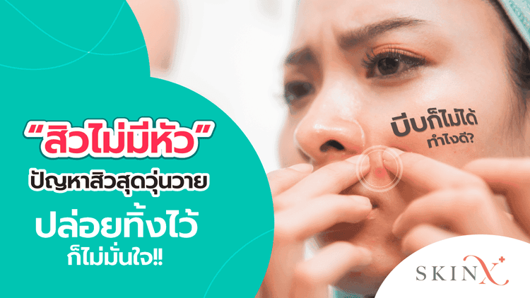 สิวไม่มีหัว ปัญหาสิวสุดวุ่นวาย บีบก็ไม่ได้ ปล่อยทิ้งไว้ก็ไม่มั่นใจ ทำไงดี?