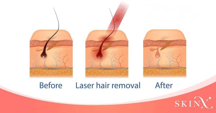 เลเซอร์ขนที่ไหนดี ให้ผิวเรียบเนียน ใสกิ๊กเหมือนเด็กอีกครั้ง