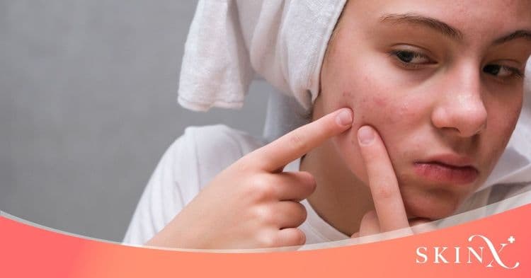 สิวที่แก้ม ปัญหาผิวหน้าเรื้อรัง คืออะไร?