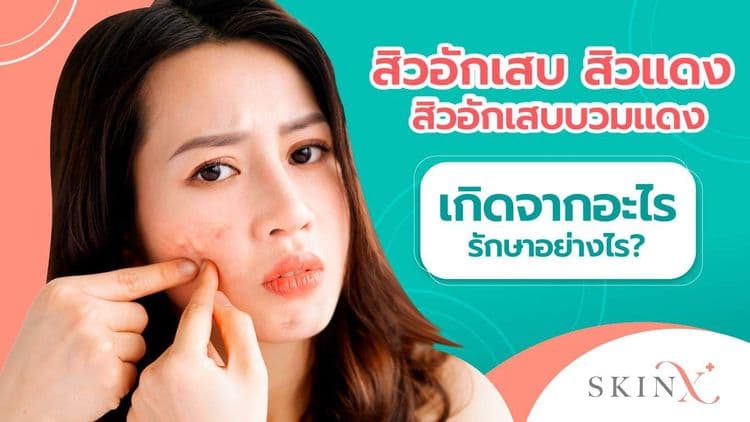 สิวอักเสบ (Inflammatory Acne) ปัญหาผิวเรื้อรังที่เกิดจากแบคทีเรีย!