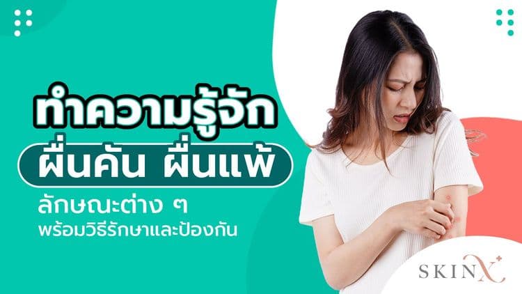 ทำความรู้จัก ผื่นคัน ผื่นแพ้ ลักษณะต่าง ๆ พร้อมวิธีรักษาและป้องกัน