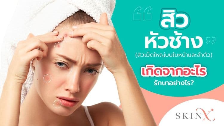 สิวหัวช้าง สิวอักเสบขนาดใหญ่ต้นเหตุแผลเป็นเกิดจากอะไร? รักษาได้หรือไม่?