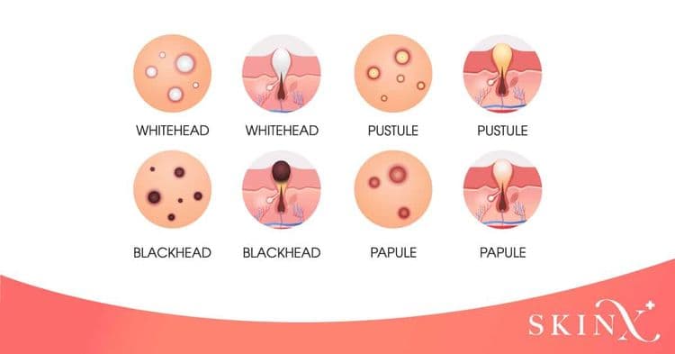 ทำความรู้จักกับสาเหตุของ “สิวที่หลัง” เกิดจากอะไรกันแน่ ?
