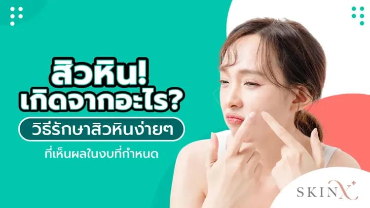 สิวหินเกิดจากอะไร? วิธีรักษาสิวหิน ง่าย ๆ ที่เห็นผลในงบที่กำหนด