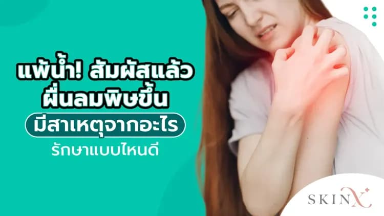 แพ้น้ำ สัมผัสแล้วผื่นลมพิษขึ้น มีสาเหตุจากอะไร รักษาแบบไหนดี