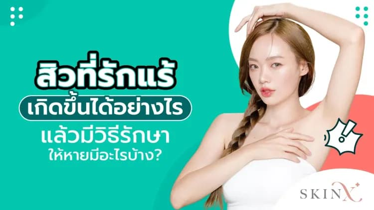 สิวที่รักแร้ เกิดขึ้นได้อย่างไร แล้วมีวิธีรักษาให้หายมีอะไรบ้าง?