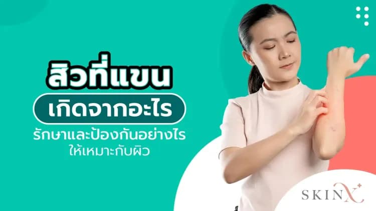 สิวที่แขน เกิดจากอะไร รักษาและป้องกันอย่างไรให้เหมาะกับผิว