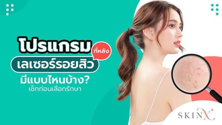 โปรแกรมเลเซอร์รอยสิวที่หลัง มีแบบไหนบ้าง? เช็กก่อนเลือกรักษา
