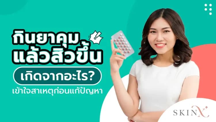 กินยาคุมแล้วสิวขึ้น เกิดจากอะไร? เข้าใจสาเหตุก่อนแก้ปัญหา