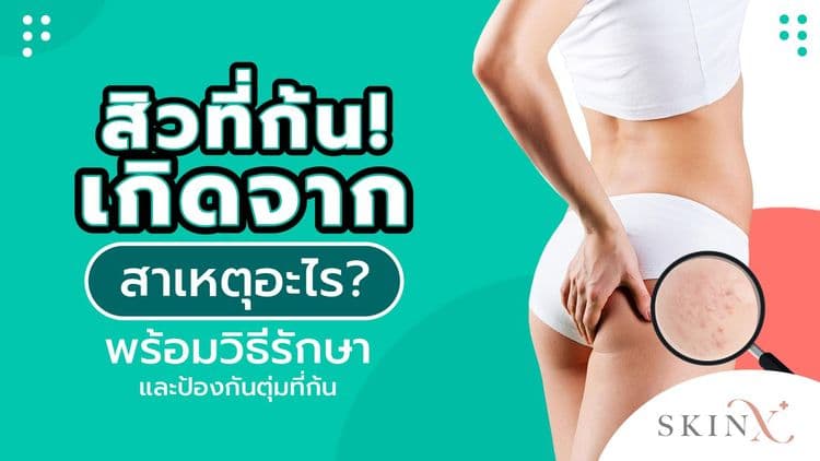 สิวที่ก้นเกิดจากอะไร? พร้อมวิธีรักษาและป้องกันตุ่มที่ก้น