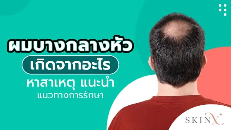 ผมบางกลางหัวเกิดจากอะไร หาสาเหตุ แนะนำแนวทางการรักษา