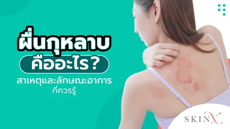 ผื่นกุหลาบ คืออะไร? สาเหตุและลักษณะอาการที่ควรรู้