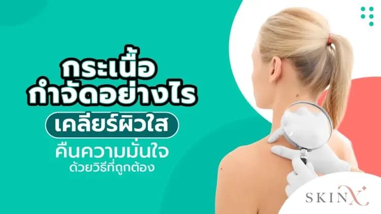 กระเนื้อกำจัดอย่างไร เคลียร์ผิวใส คืนความมั่นใจ ด้วยวิธีที่ถูกต้อง