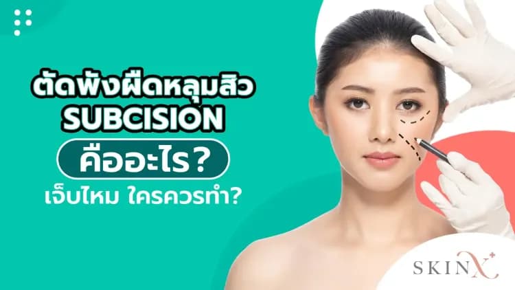 ตัดพังผืดหลุมสิว (Subcision) คืออะไร? เจ็บไหม ใครควรทำ?