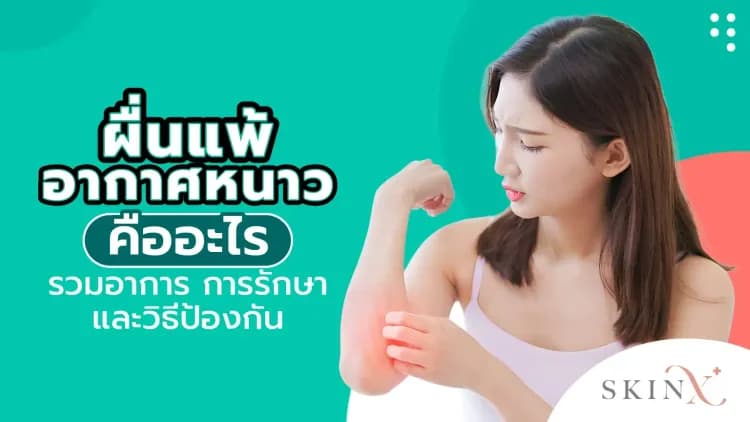 ผื่นแพ้อากาศหนาว คืออะไร รวมอาการ การรักษา และวิธีป้องกัน
