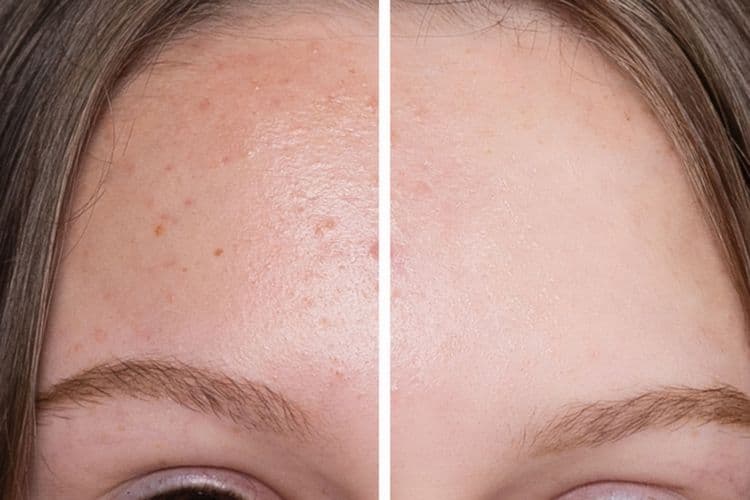 วิธีรักษาสิวผดแบบเร่งด่วน เผยใบหน้าขาวใสเรียบเนียนด้วยตัวเอง