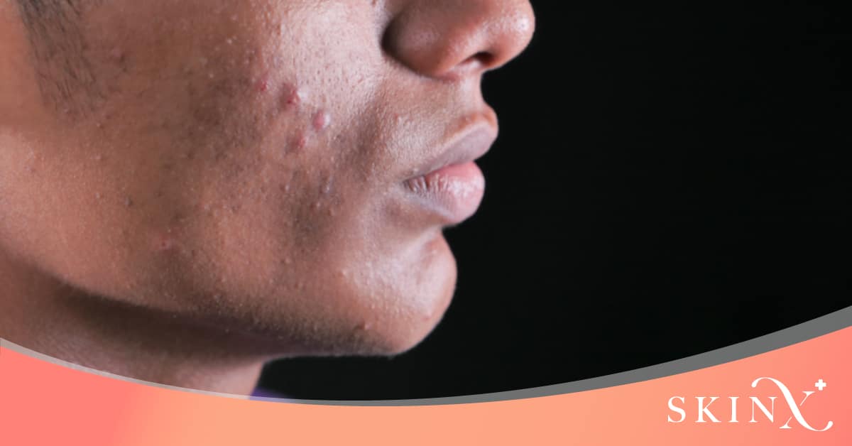 สิวหัวช้าง Nodulocystic acne หรือ Severe Nodular acne